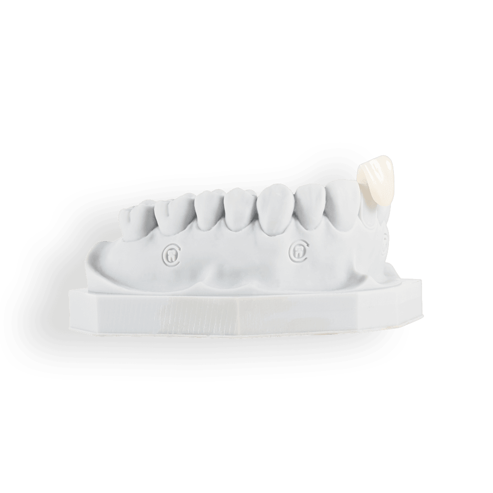 Jacket Crowns