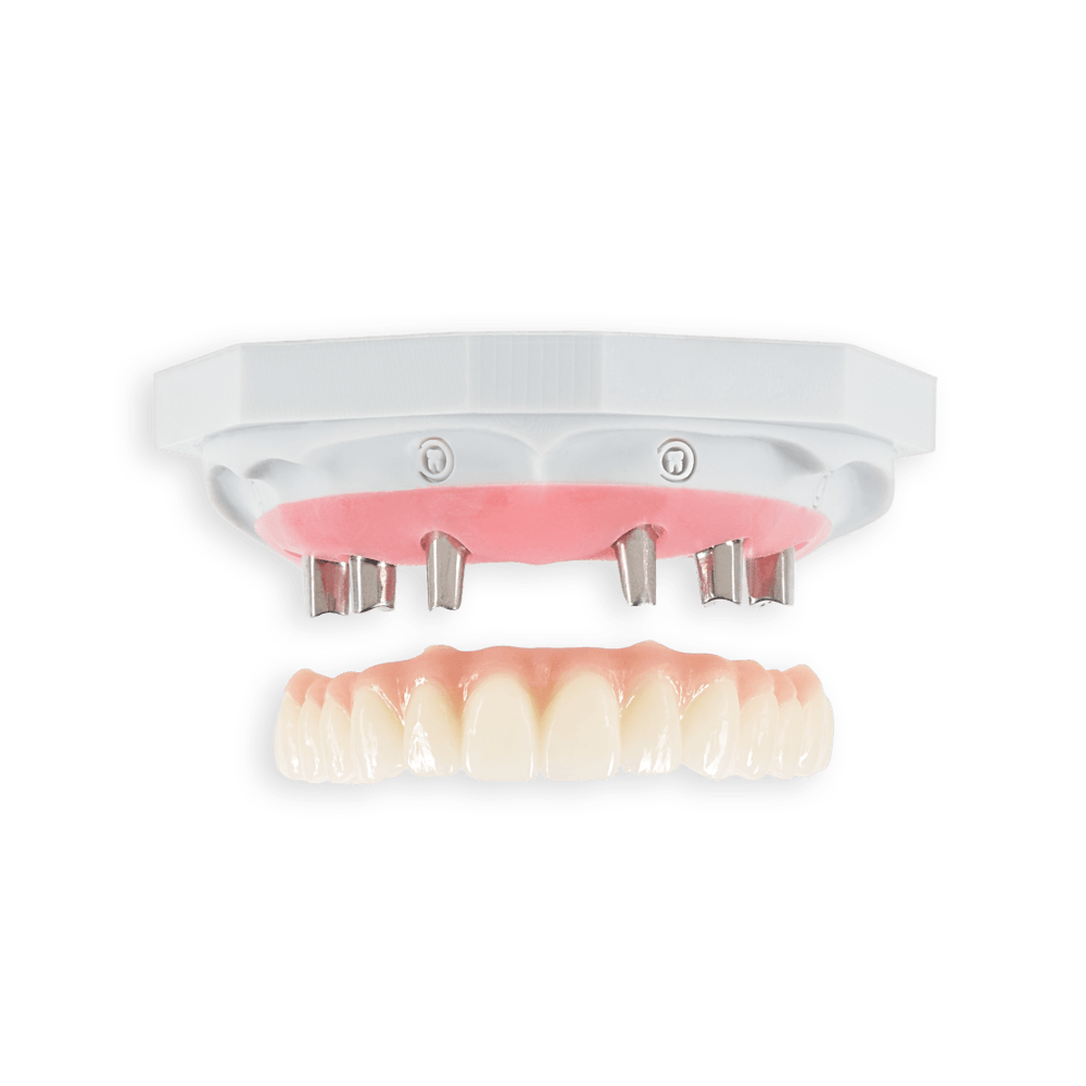 Cement Retained implant restoration