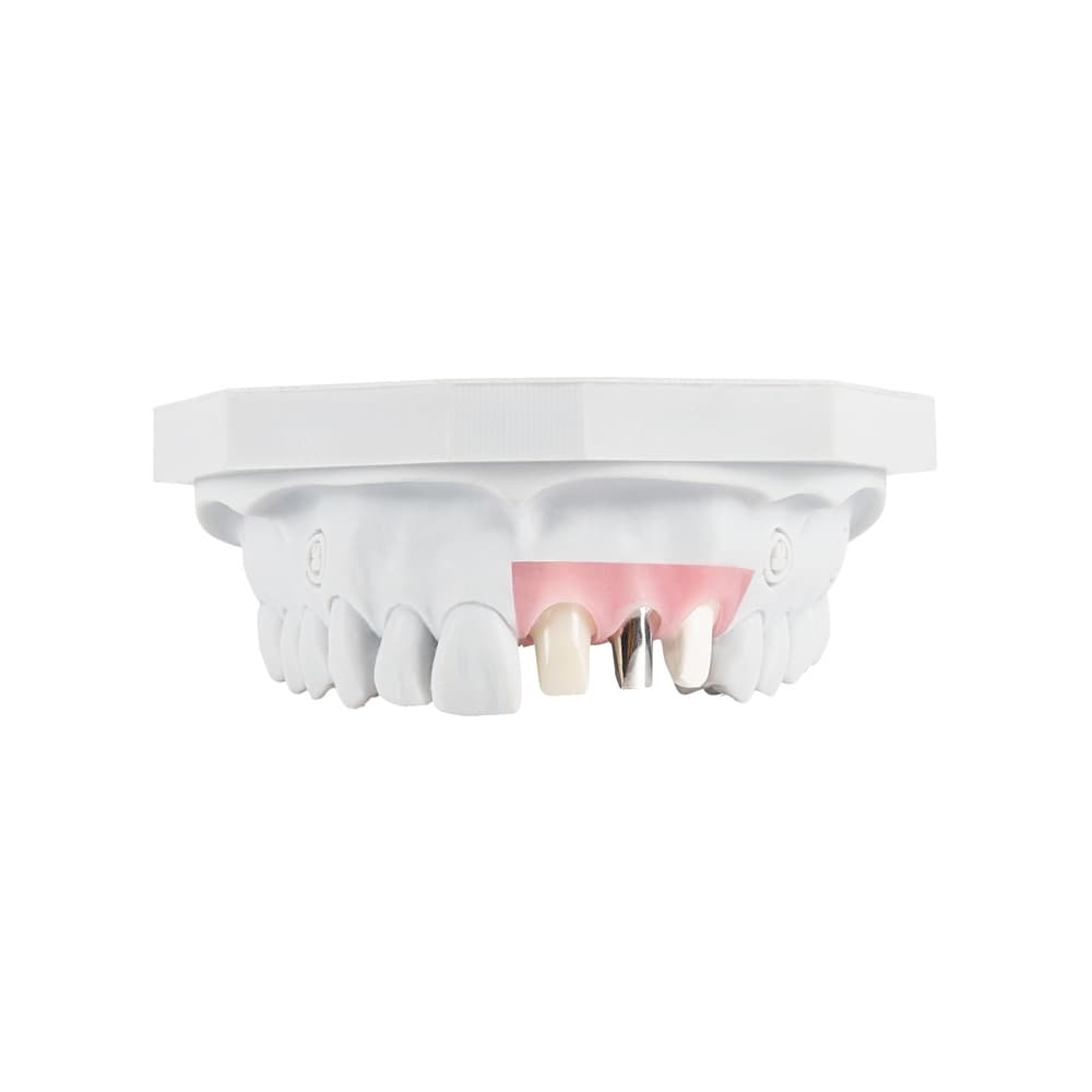 Custom Abutments gallery image 1