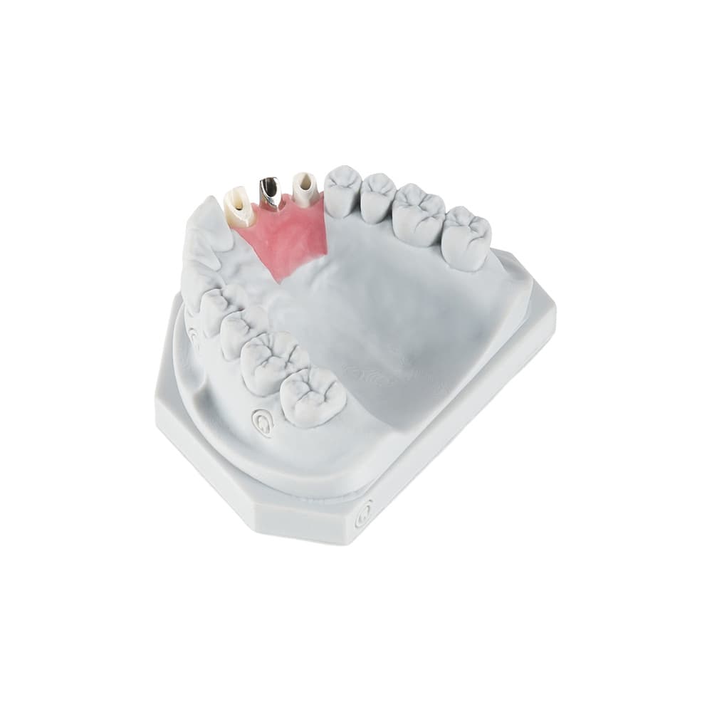 Custom Abutments gallery image 3