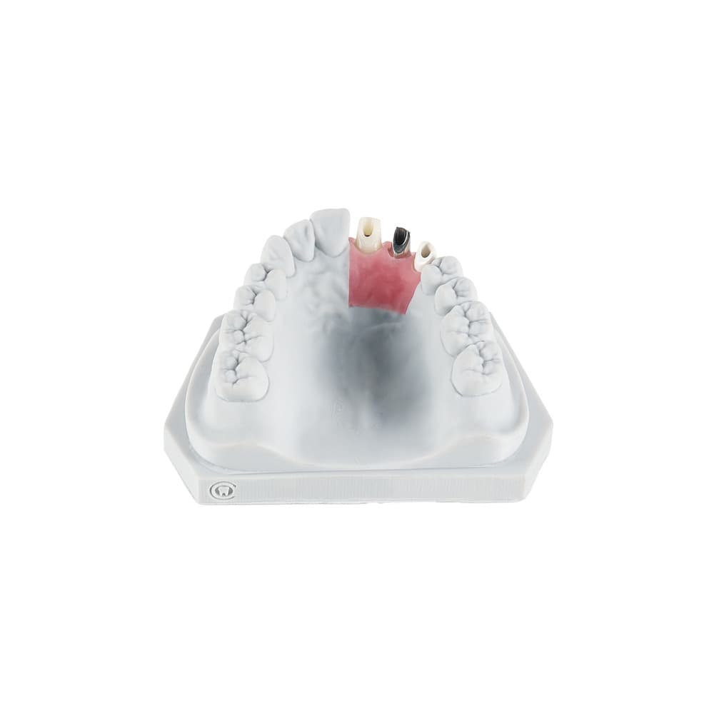 Custom Abutments gallery image 4