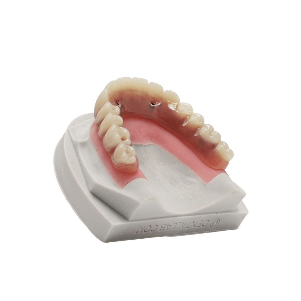Screw-Retained Denture