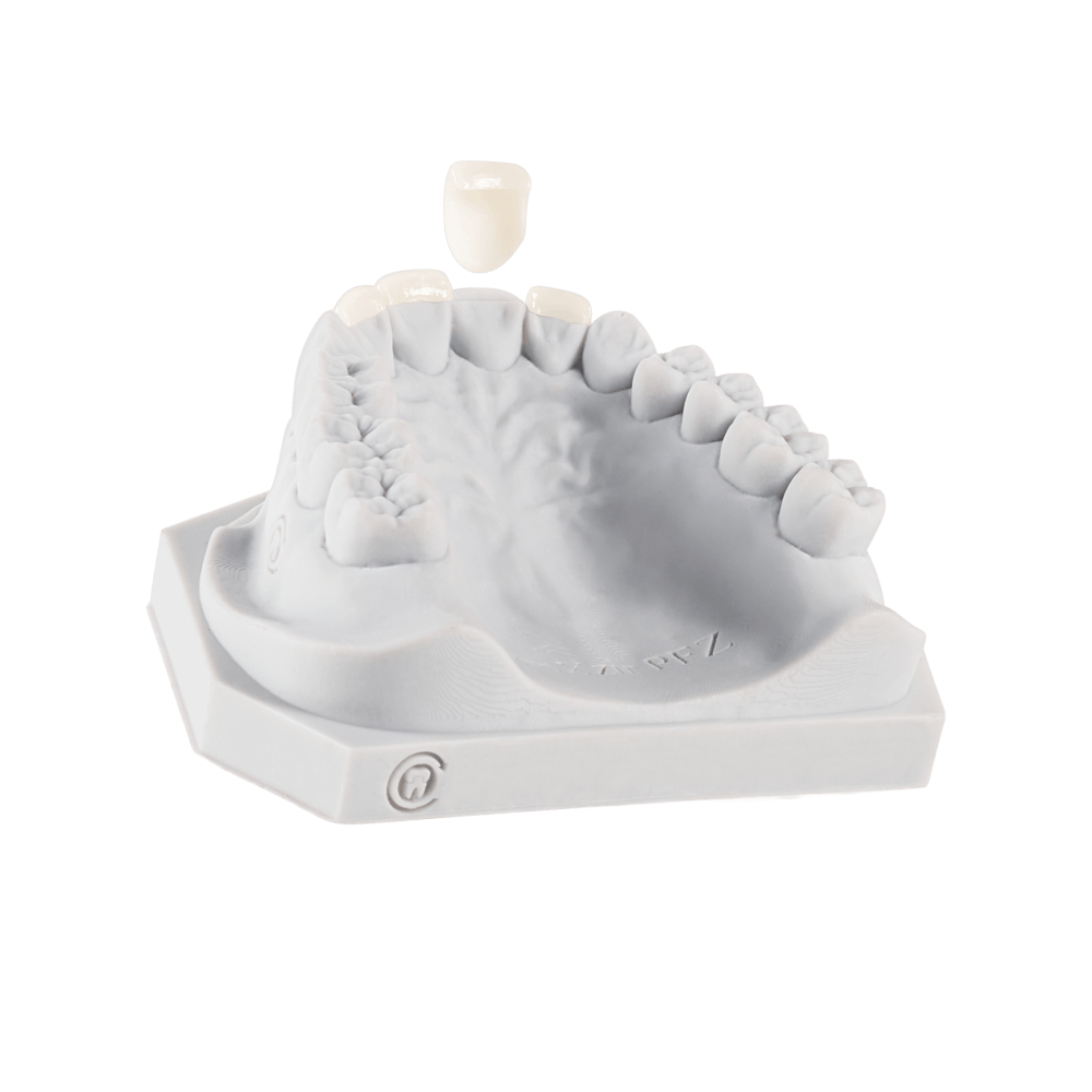 Porcelain veneers