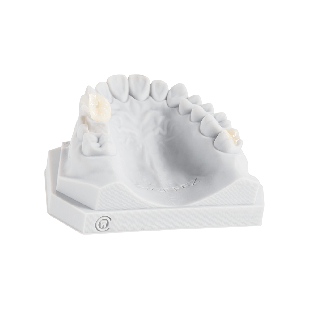 Dental inlays and onlays