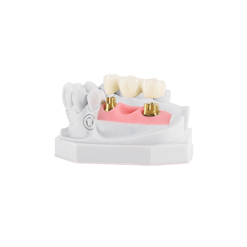 Implant-supported restoration