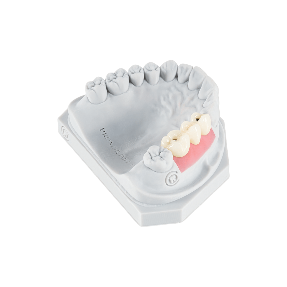 Screw Retained implant