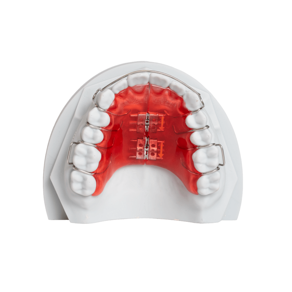 Palatal expander