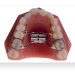 Palatal Expander